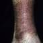28. Застойный дерматит на ногах фото
