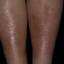 31. Застойный дерматит на ногах фото