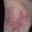 4. Застойный дерматит на ногах фото
