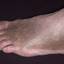 41. Застойный дерматит на ногах фото