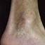 47. Застойный дерматит на ногах фото