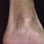 49. Застойный дерматит на ногах фото
