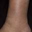 5. Застойный дерматит на ногах фото