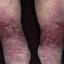 51. Застойный дерматит на ногах фото