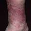 53. Застойный дерматит на ногах фото
