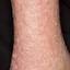 54. Застойный дерматит на ногах фото