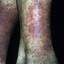 59. Застойный дерматит на ногах фото