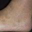 6. Застойный дерматит на ногах фото