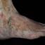 60. Застойный дерматит на ногах фото