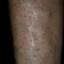 7. Застойный дерматит на ногах фото