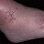 8. Застойный дерматит на ногах фото
