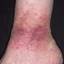 82. Застойный дерматит на ногах фото