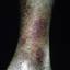 9. Застойный дерматит на ногах фото