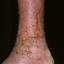 92. Застойный дерматит на ногах фото