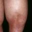 96. Застойный дерматит на ногах фото