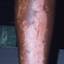 15. Контактный дерматит на ногах фото