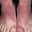 19. Контактный дерматит на ногах фото