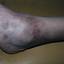 4. Контактный дерматит на ногах фото
