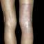 6. Контактный дерматит на ногах фото