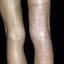 7. Контактный дерматит на ногах фото