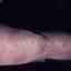 9. Контактный дерматит на ногах фото