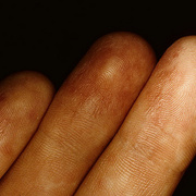 Начальная стадия экземы на пальцах рук