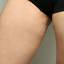 2. Признаки варикоза ног у женщин фото
