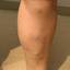 3. Признаки варикоза ног у женщин фото