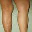9. Признаки варикоза ног у женщин фото