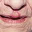 6. Кератоакантома губы фото