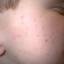 3. Кератоз кожи лица фото