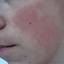 6. Кератоз кожи лица фото