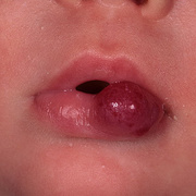 Гемангиома губы