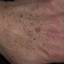 157. Старческий кератоз кожи фото