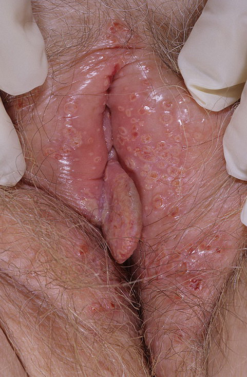 Herpes genitalis in der scheide - 🧡 Genital herpes 💖 Genital herpes: The ...
