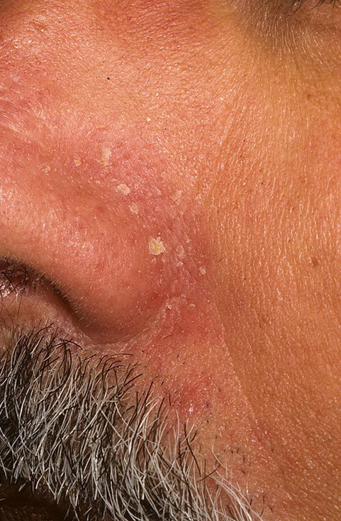 Как выглядит болезнь себорея фото – 287 шт. / nezdorov.com