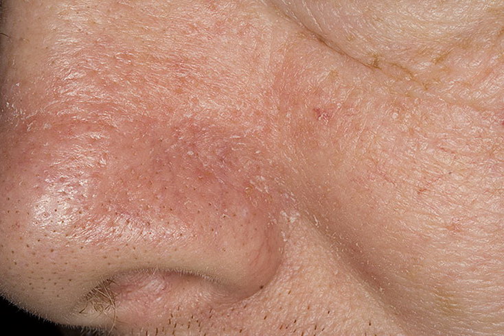 Как выглядит болезнь себорея фото – 287 шт. / nezdorov.com