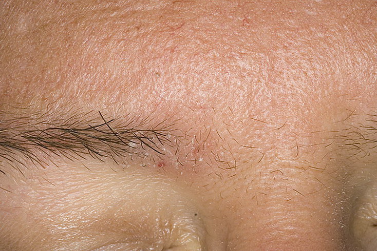 Как выглядит болезнь себорея фото – 287 шт. / nezdorov.com