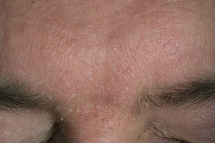 Как выглядит болезнь себорея фото – 287 шт. / nezdorov.com