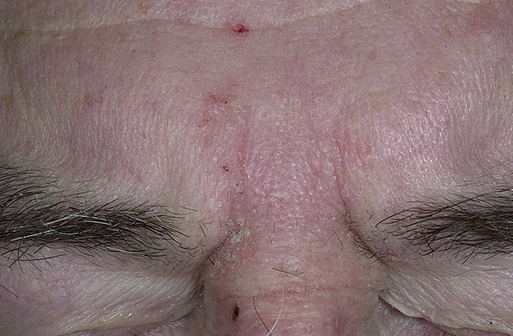 Как выглядит болезнь себорея фото – 287 шт. / nezdorov.com