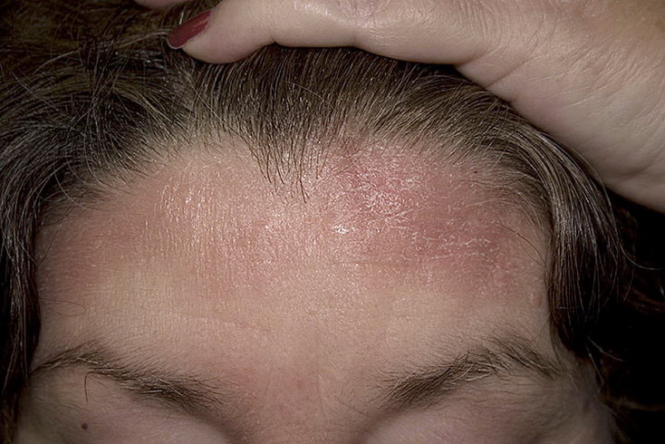 Как выглядит болезнь себорея фото – 287 шт. / nezdorov.com