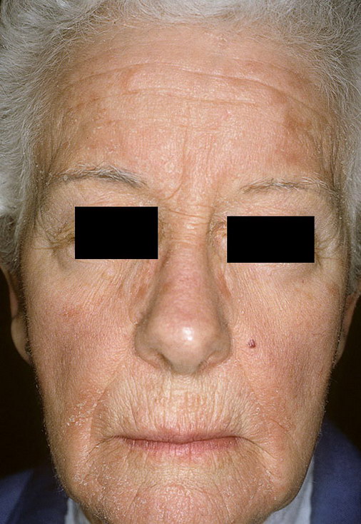 Как выглядит болезнь себорея фото – 287 шт. / nezdorov.com