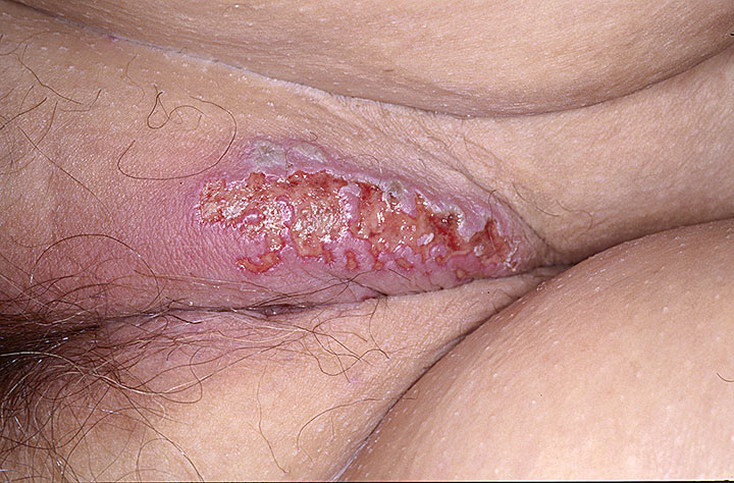 Darmbakterien symptome