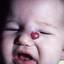 1. Кавернозная гемангиома у новорожденных фото