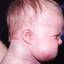 4. Кавернозная гемангиома у новорожденных фото