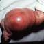9. Кавернозная гемангиома у новорожденных фото