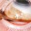 1. Меланома глаза фото