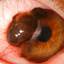 11. Меланома глаза фото