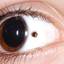 2. Меланома глаза фото