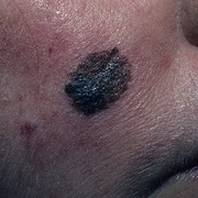 Меланома на лице